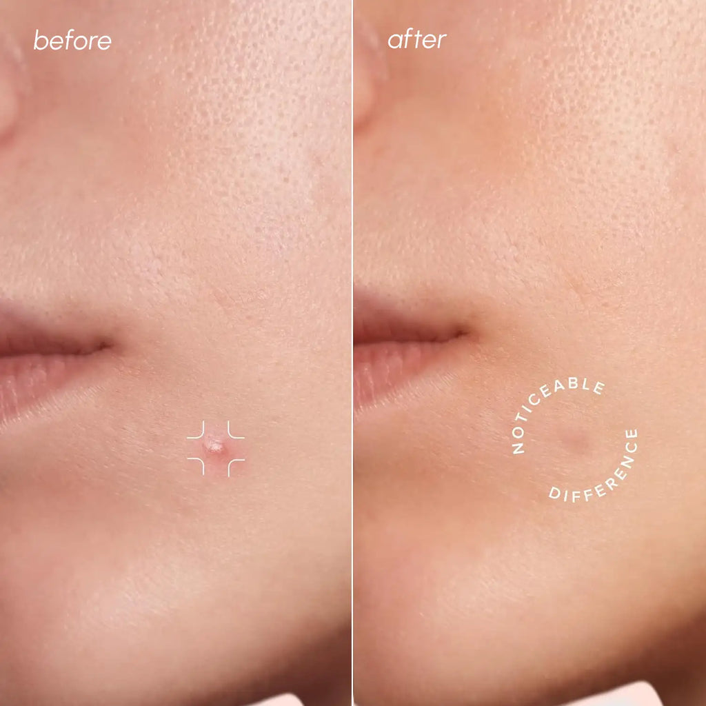 Maree Invisible Pimple & Acne Patches — detail close-up