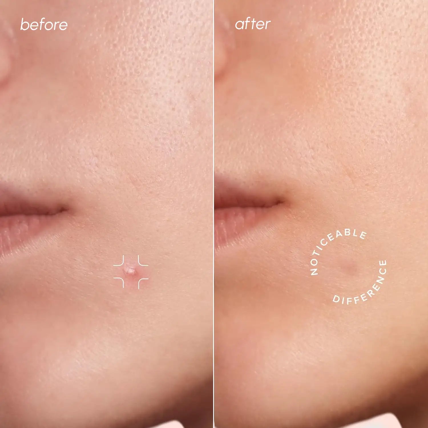 Maree Invisible Pimple & Acne Patches — detail close-up
