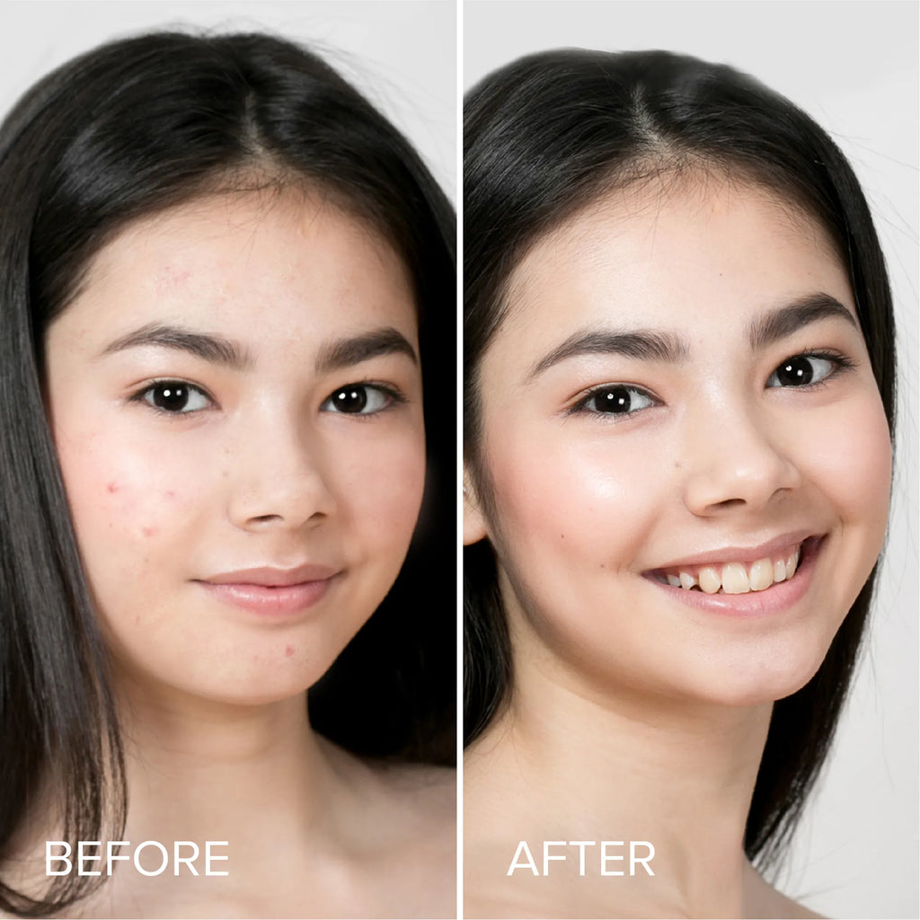 Maree Pimple & Acne Patches — lifestyle context