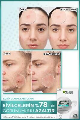 Garnier Pure Active: Anti-Acne Pore Strips with Salicylic Acid & Tea Tree Oil - Blackhead Remover, Facial Cleanser (22 Strips)