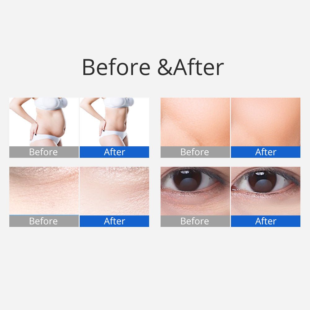 Shape Tactics 3-in-1 40K Ultrasonic Cavitation RF Slimming Machine – Cavitation Machines, view 12
