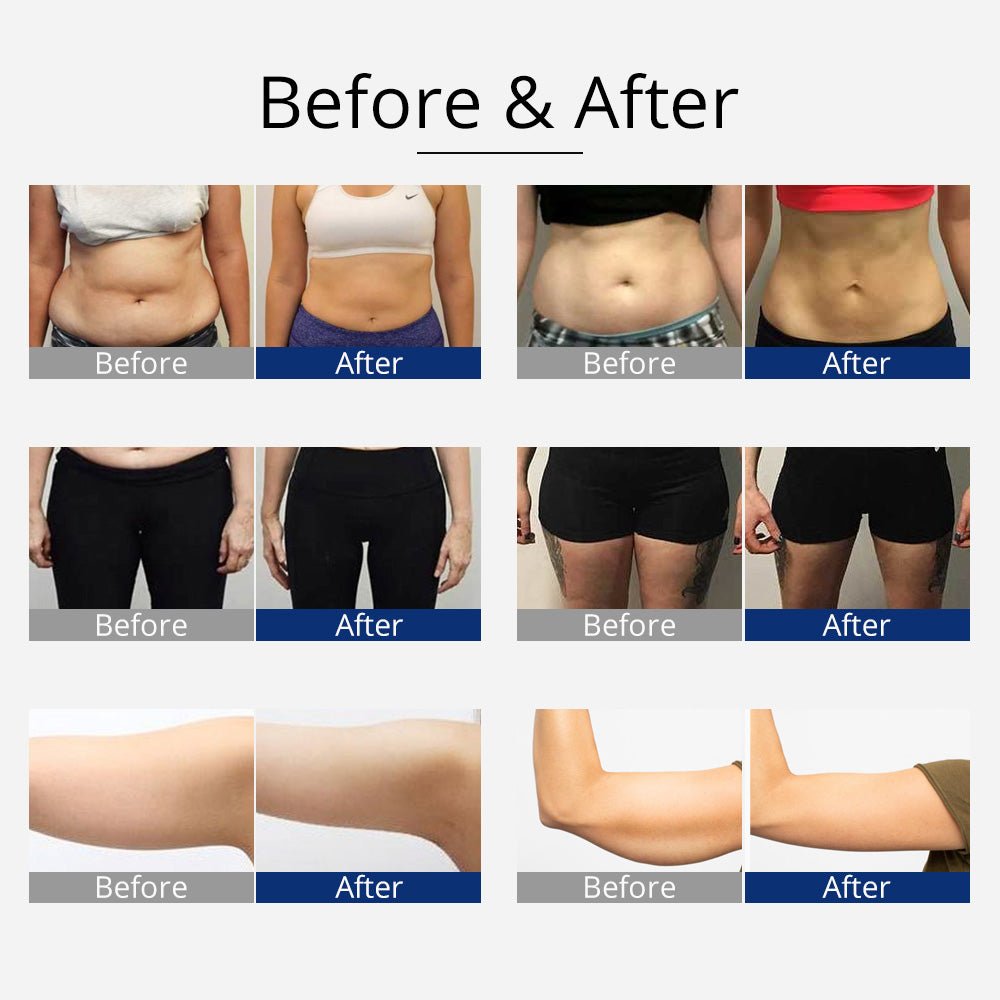 Shape Tactics 360° RF Cavitation & Vacuum Body Contouring System – Cavitation Machines, view 15