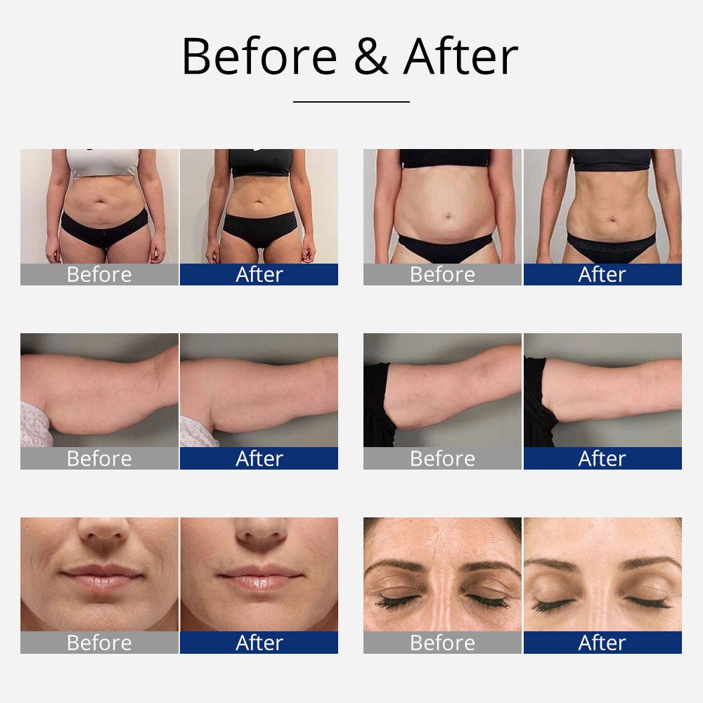 Shape Tactics 4-in-1 Cavitation, RF, and EMS Body Sculpting System – Cavitation Machines, view 11