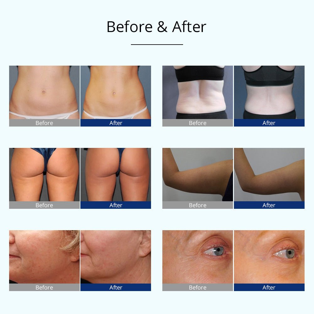 Shape Tactics 4-in-1 Cryolipolysis Cavitation RF Body Contouring System – Cavitation Machines, view 15