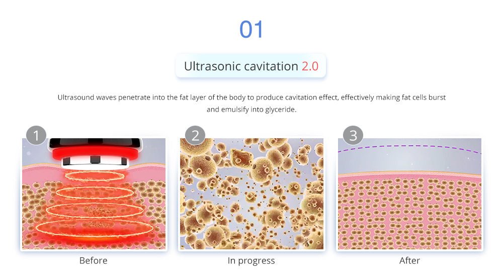 Shape Tactics 4-in-1 Cryolipolysis Cavitation RF Body Contouring System – Cavitation Machines, view 13