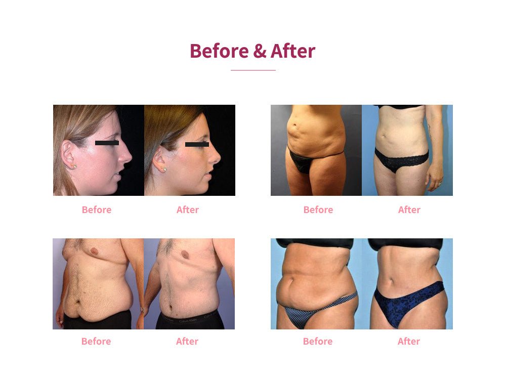 Shape Tactics 5-in-1 Cryolipolysis Vacuum RF Cooling System – Cavitation Machines, view 15