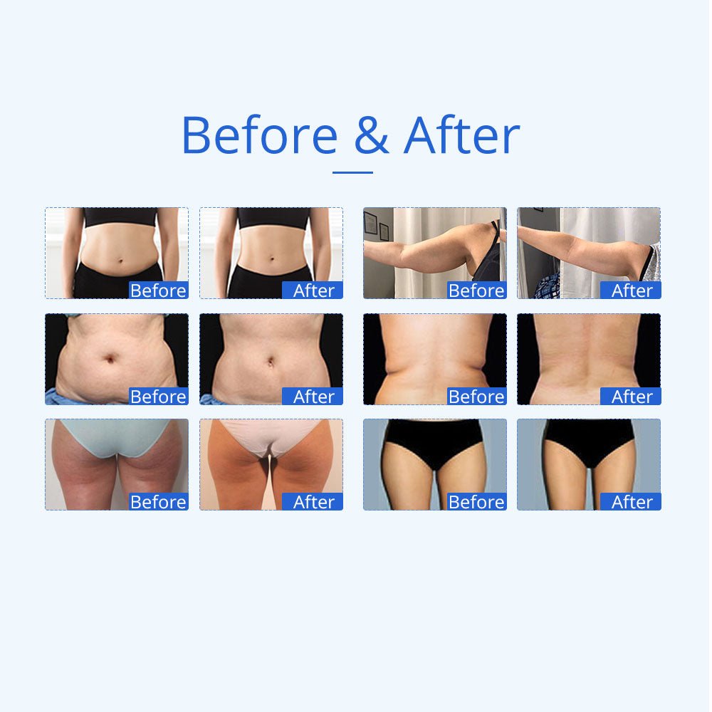 Shape Tactics 5-in-1 Unoisetion Ultrasonic RF Cavitation System – Cavitation Machines, view 14