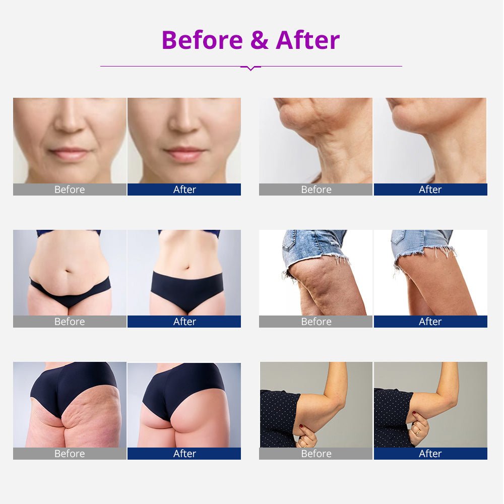 Shape Tactics 5-in-1 Cavitation RF Vacuum Body Contouring System – Cavitation Machines, view 13