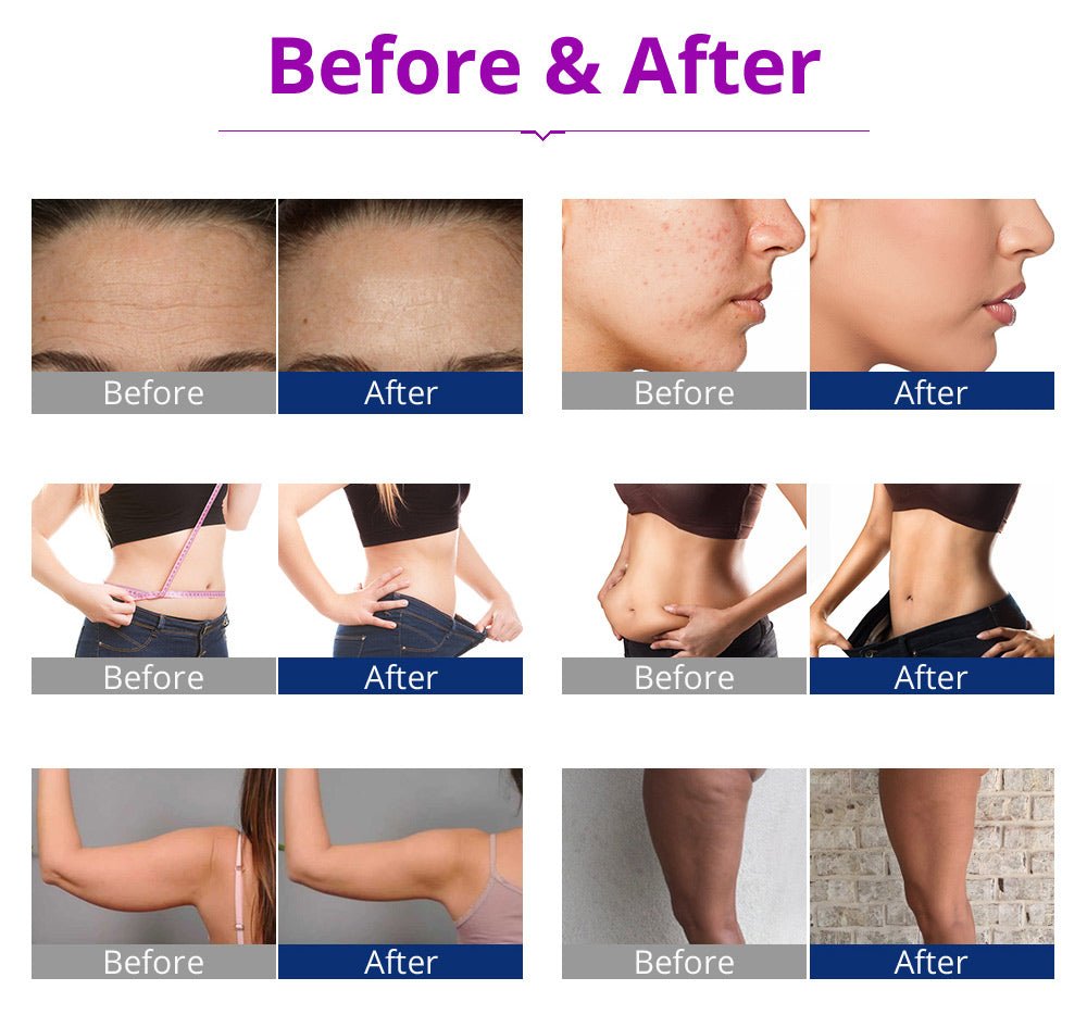 Shape Tactics 5-in-1 RF Cavitation Wellness System – Cavitation Machines, view 13