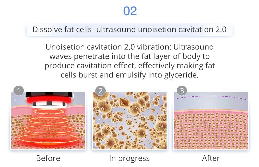 Shape Tactics 6-in-1 Unoisetion Cavitation 2.0 Vacuum RF System – Cavitation Machines, view 11