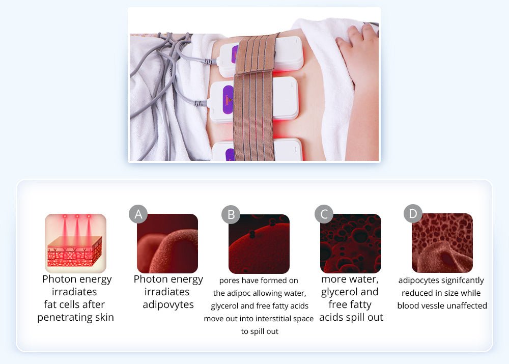 Shape Tactics 6-in-1 Unoisetion Cavitation 2.0 Vacuum RF System – Cavitation Machines, view 14