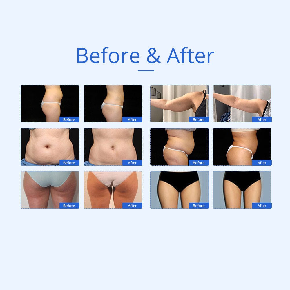 Shape Tactics 7-in-1 40K Ultrasonic Cavitation & RF Hot-Cold Therapy System – Cavitation Machines, view 16