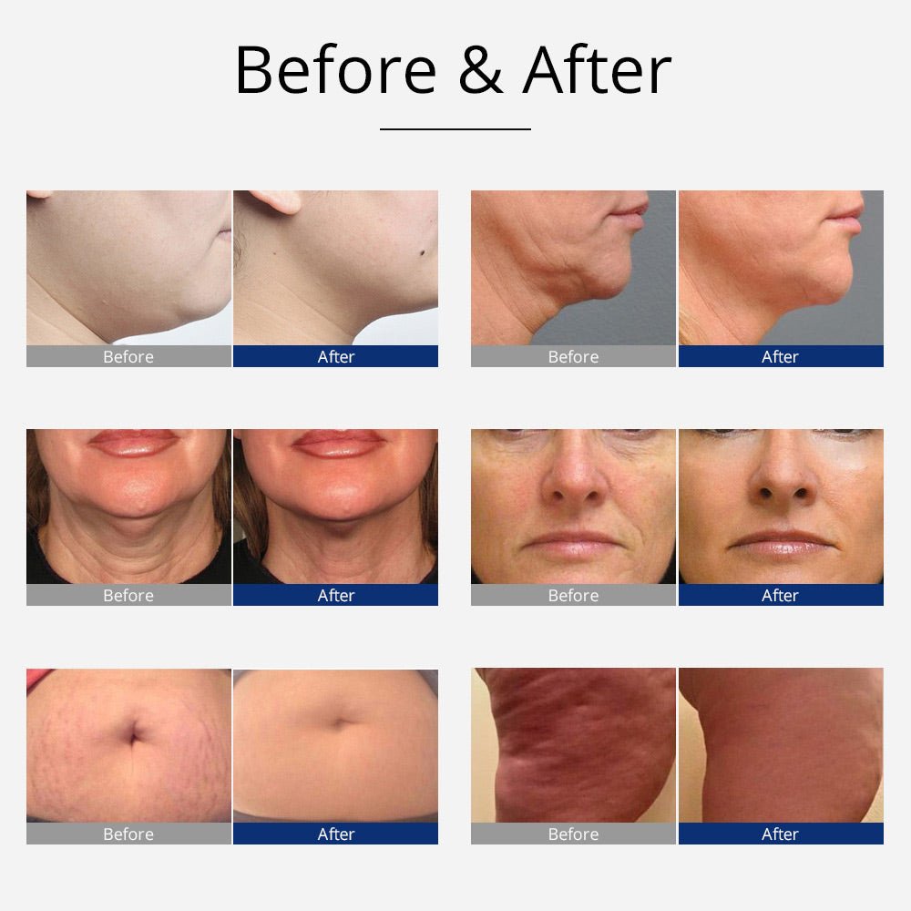 Shape Tactics 8-in-1 Cavitation RF Bio Hot and Cold Therapy System – Cavitation Machines, view 19