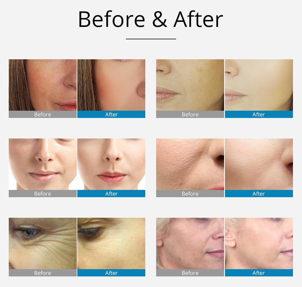 Shape Tactics 2-in-1 RF EMS Mesotherapy Skin Rejuvenation System – Cavitation Machines, view 14