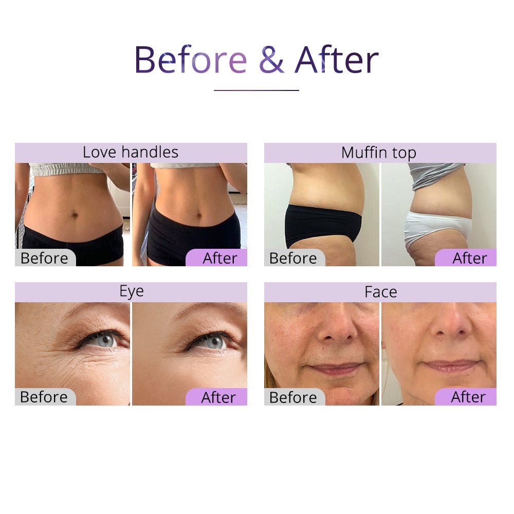 Shape Tactics 5-in-1 Cavitation Vacuum RF Body Contouring System – Cavitation Machines, view 13