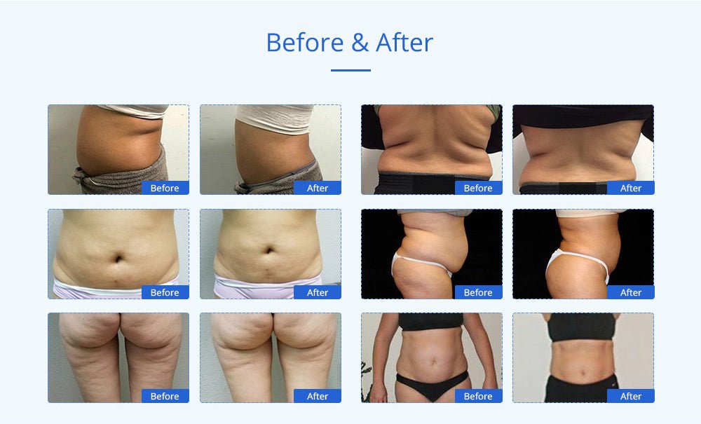 Shape Tactics Advanced 8-in-1 Unoisetion Cavitation & RF System with LED Laser Pads – Cavitation Machines, view 17