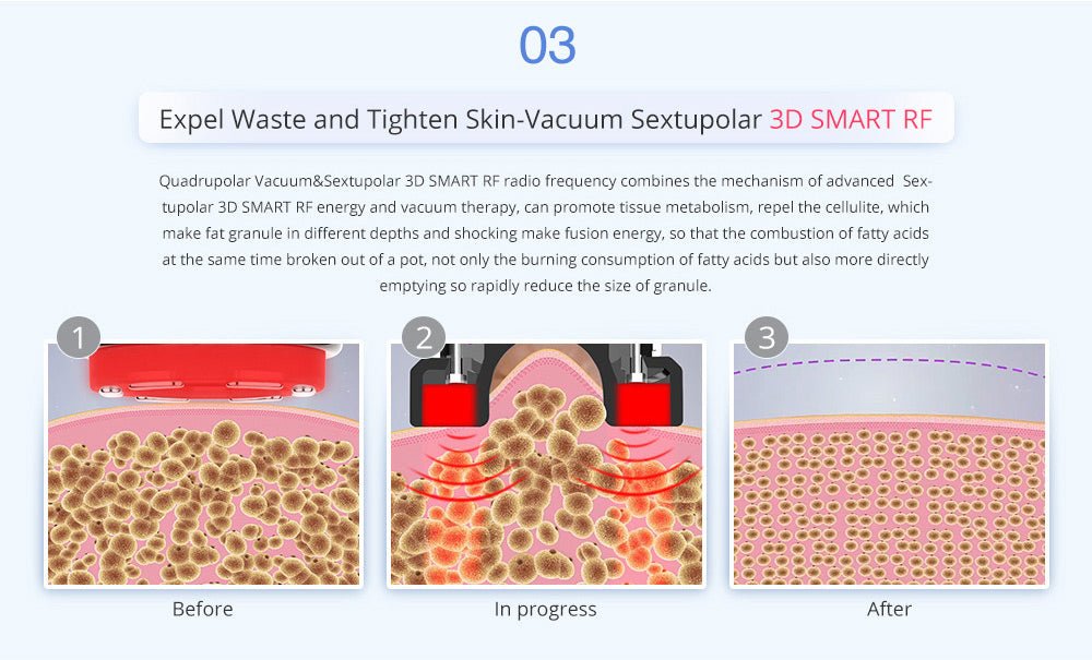 Shape Tactics Advanced 8-in-1 Unoisetion Cavitation & RF System with LED Laser Pads – Cavitation Machines, view 12