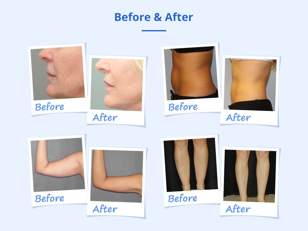 Shape Tactics Cryotherapy 40K Cavitation & RF Contouring System – Cavitation Machines, view 12