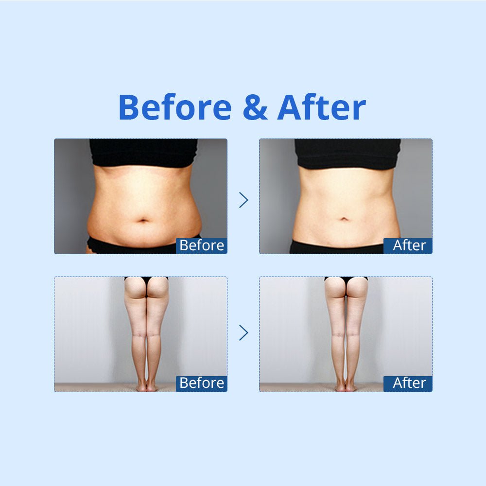 Shape Tactics Cryolipolysis Cold Vacuum Contouring System – Cavitation Machines, view 14