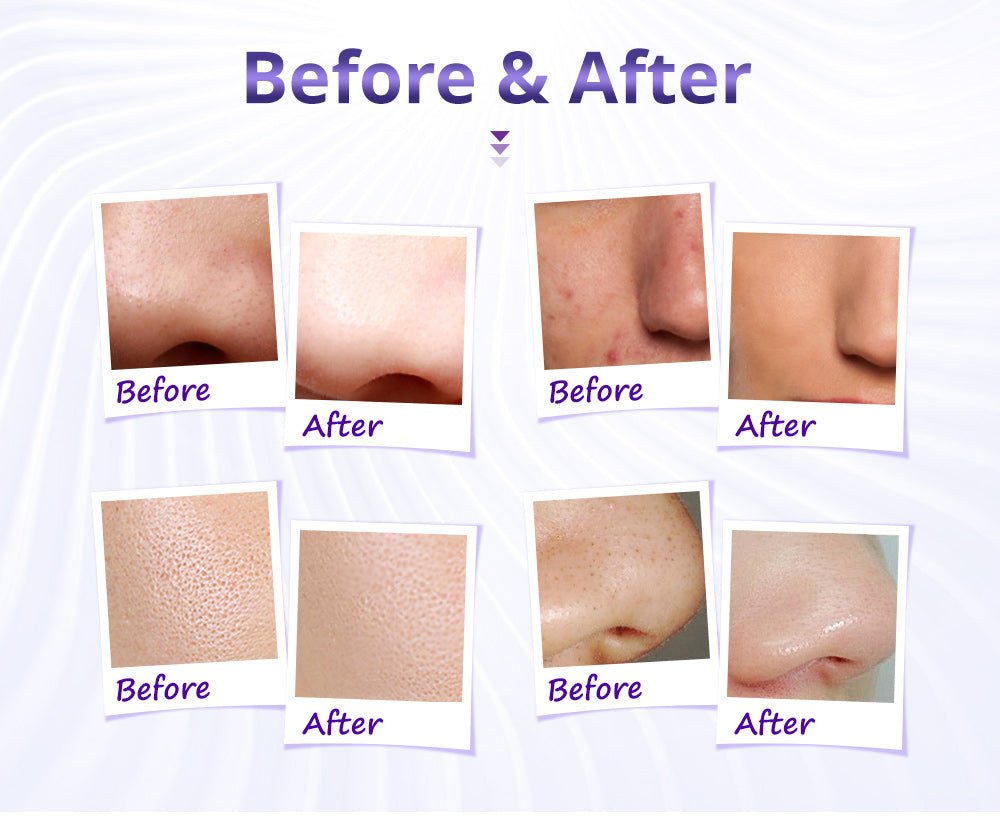 Shape Tactics Diamond Microdermabrasion & Hydrating Mist System – Cavitation Machines, view 15