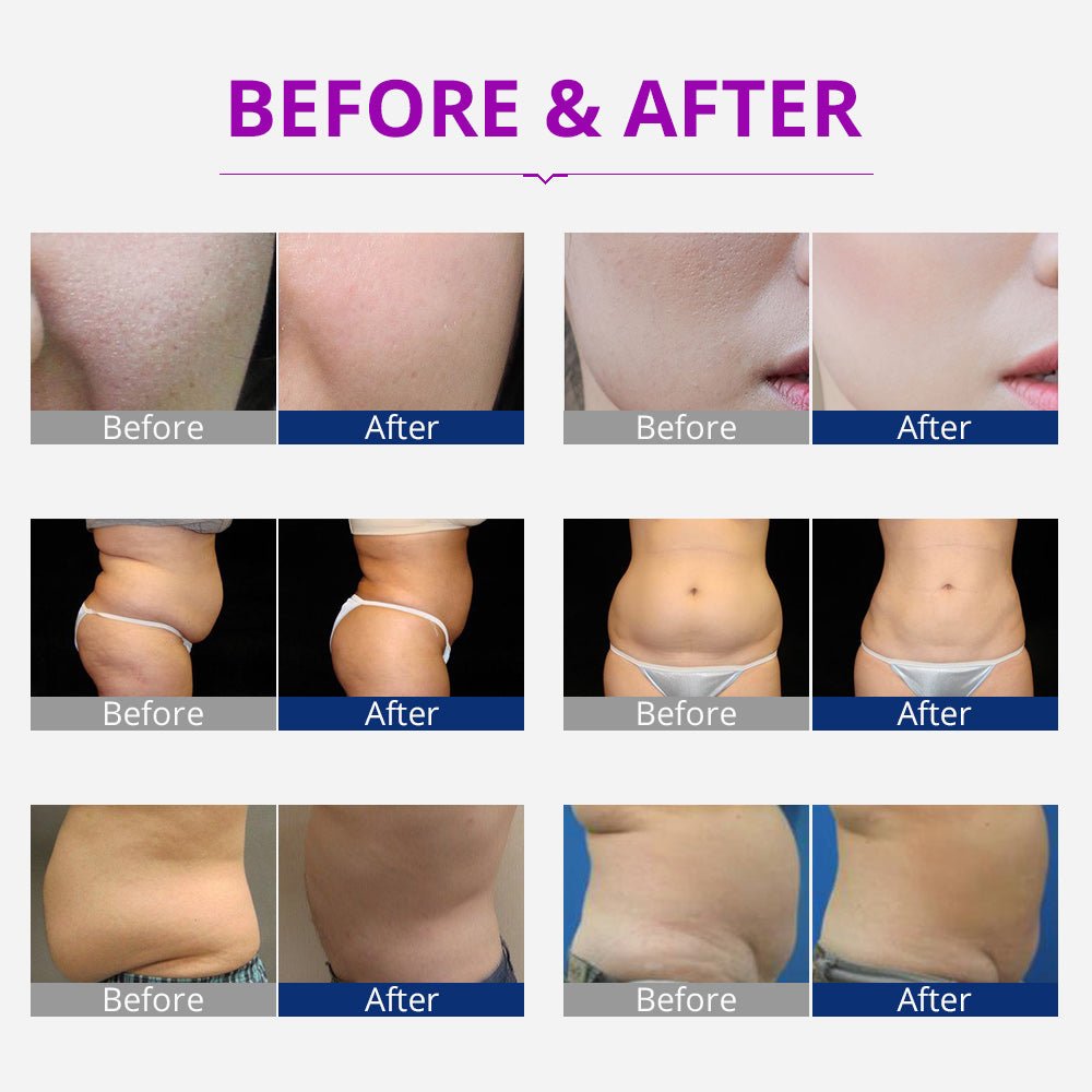 Shape Tactics Portable 5-in-1 Cavitation RF Vacuum Contouring System – Cavitation Machines, view 12