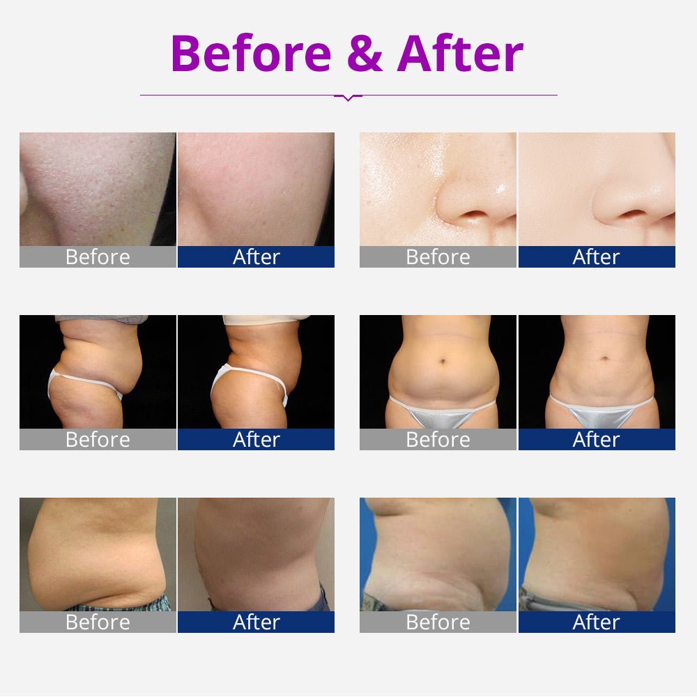 Shape Tactics Portable 6-in-1 Cavitation RF Vacuum Lipo Laser System – Cavitation Machines, view 14