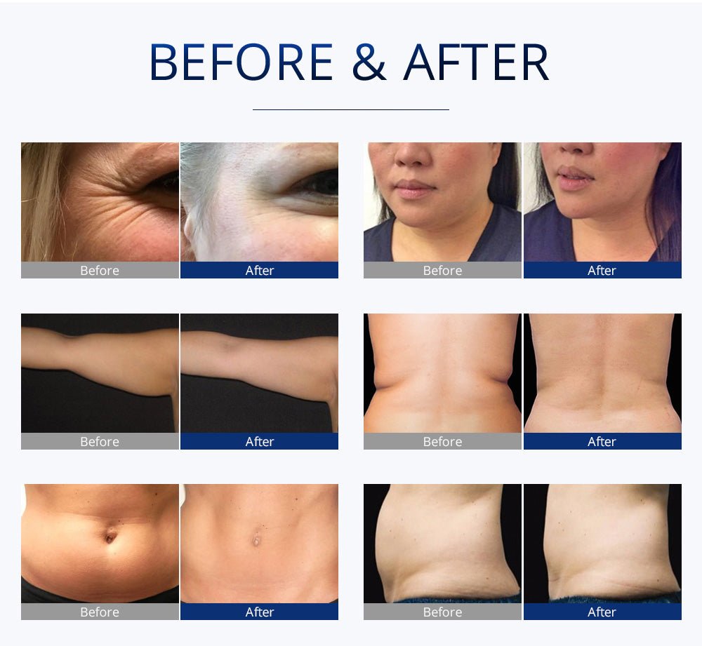 Shape Tactics S-Shape Pro 30K Cavitation RF Contouring System – Cavitation Machines, view 17