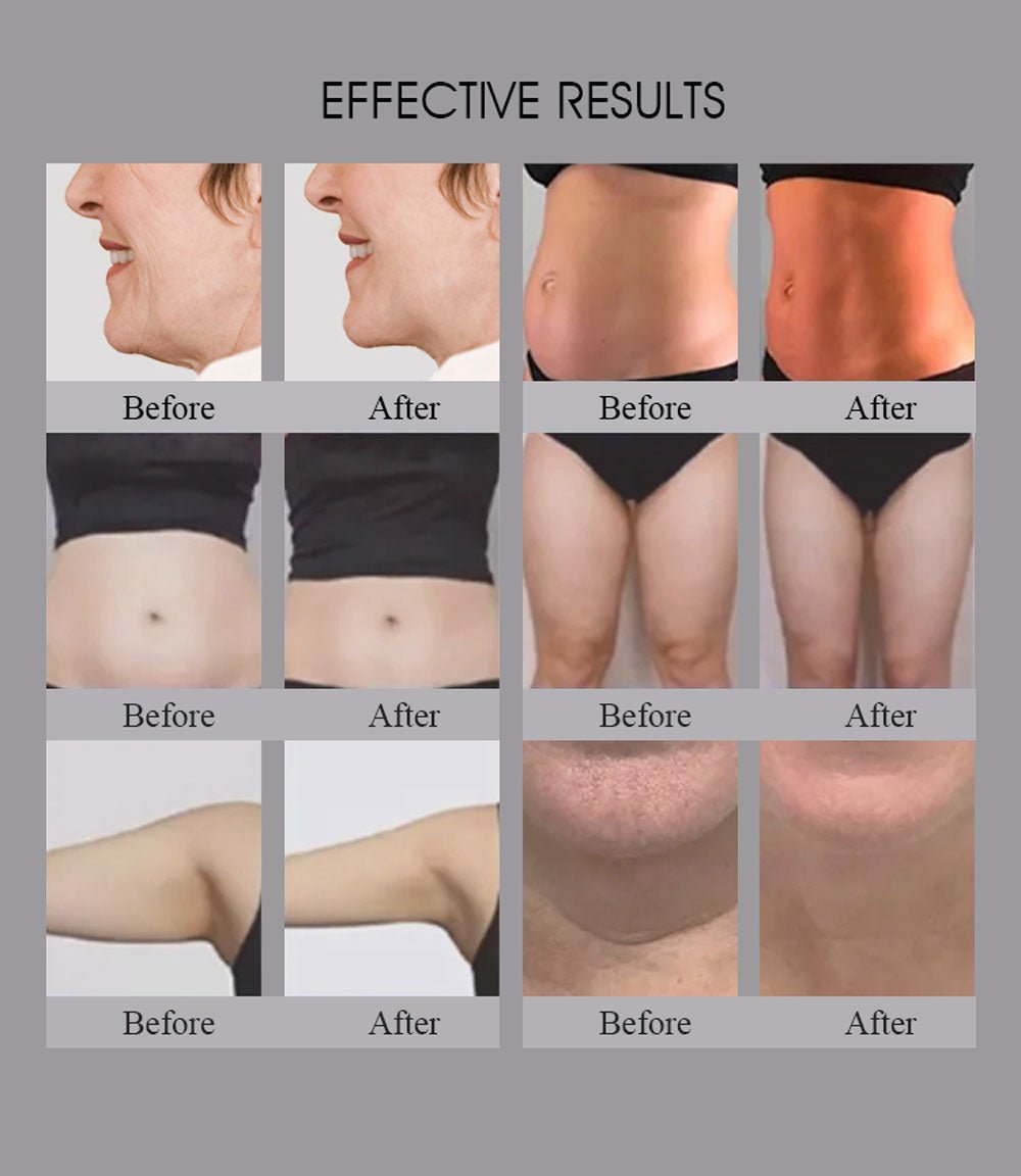 Shape Tactics Smart RF Body Contouring and Skin Rejuvenation System – Cavitation Machines, view 6
