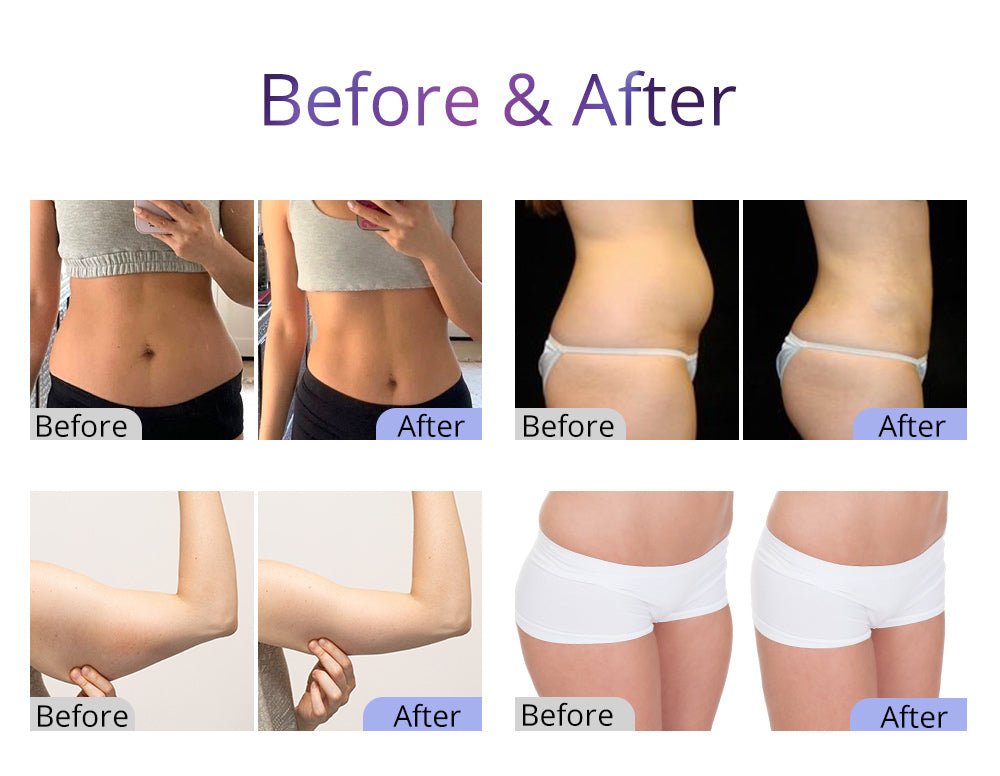 Shape Tactics UltraShape 2.5 Cavitation System – Cavitation Machines, view 14