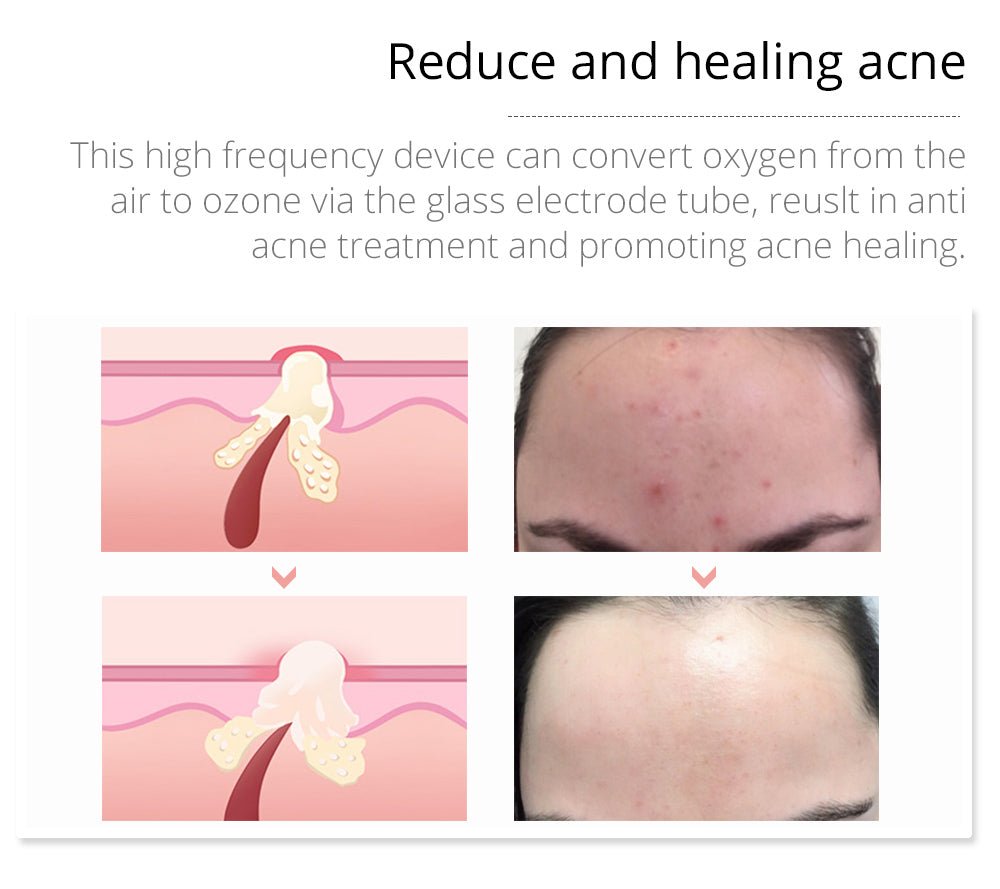 Shape Tactics Violet 7-Electrode High-Frequency Facial System – Cavitation Machines, view 18