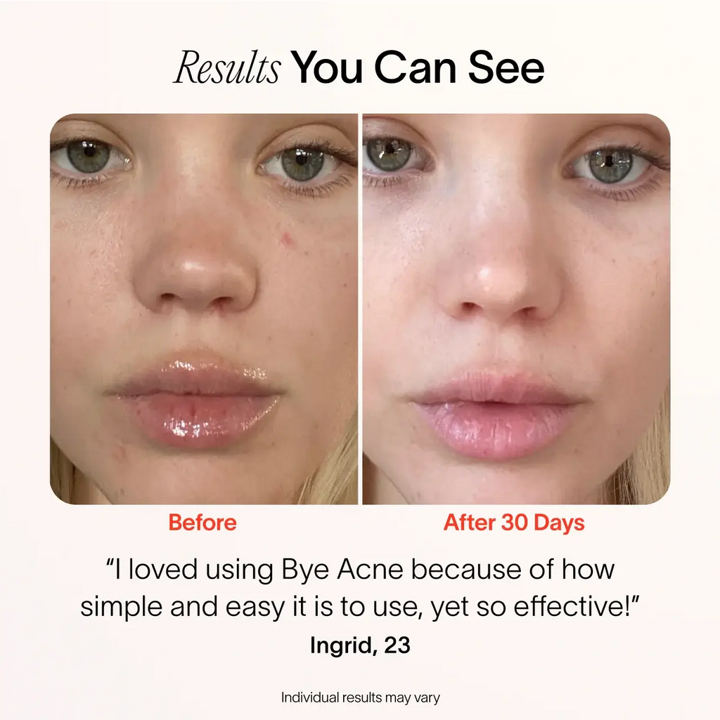Bye Acne: 3-Minute Pimple Spot Treatment – Solawave, view 6