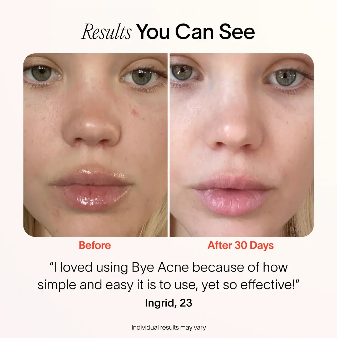 Bye Acne: 3-Minute Pimple Spot Treatment – Solawave, view 12