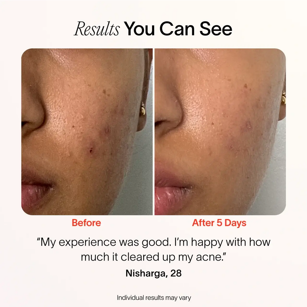 Bye Acne: 3-Minute Pimple Spot Treatment – Solawave, view 11